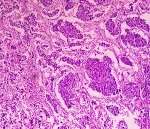 Carcinome à cellules transitionnelles