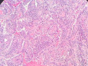 Carcinome papillaire de la thyroïde