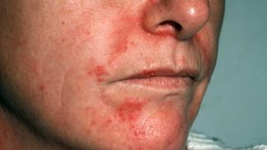 Dermite (ou dermatite) de contact