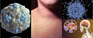 Infections par échovirus