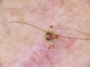 Infestation par des poux du pubis