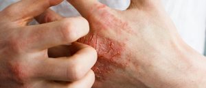 Types d'eczéma