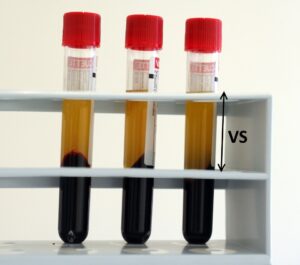 vitesse de sédimentation